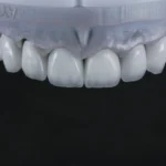 E.max Crowns