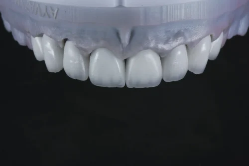 E.max Crowns