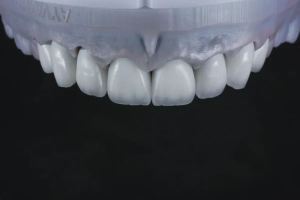 E.max Crowns