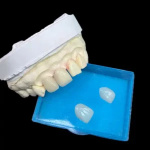 Full E.max Veneer (Monolithic) When Consistency Beats Layering