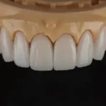 Full E.max Veneer
