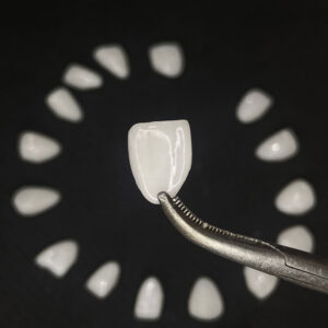 Full E.max Veneers vs Layered E.max Veneers What Is the Real Difference