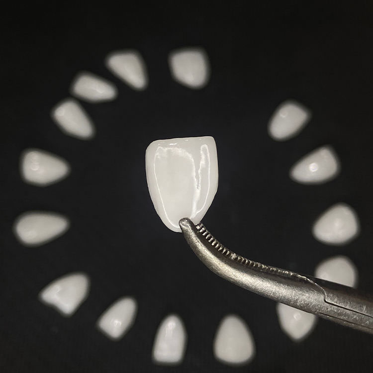 Faccette E.max complete vs faccette E.max stratificate Qual è la vera differenza?
