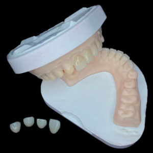 E.max Veneers