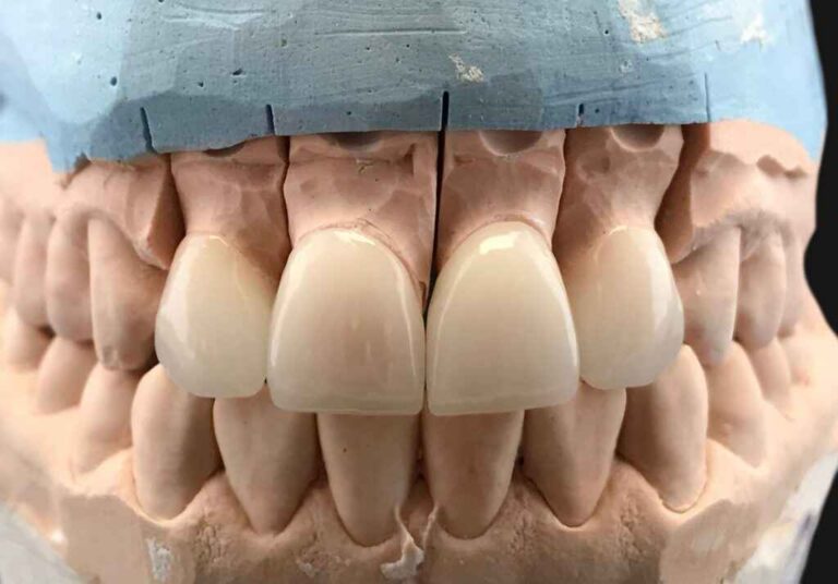 Are E.max Crowns Suitable for High-Occlusion Back Situations
