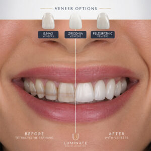 Tetracycline-Stained Teeth