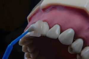 Zirconia Veneers