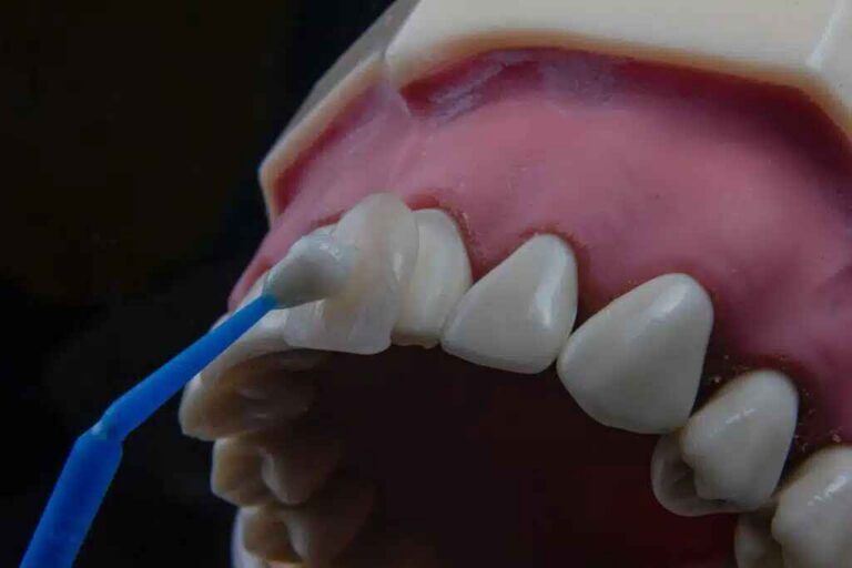 Zirconia Veneers