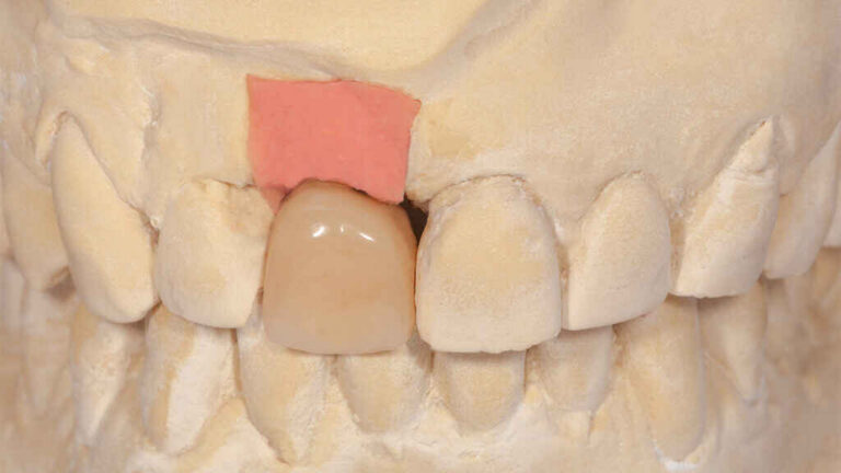 Anterior Cases