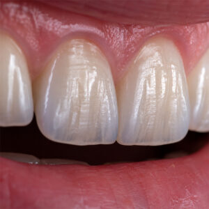 Why Surface Texture Determines Realism in Anterior Cases