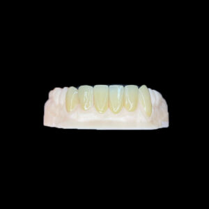 Zirconia Veneers