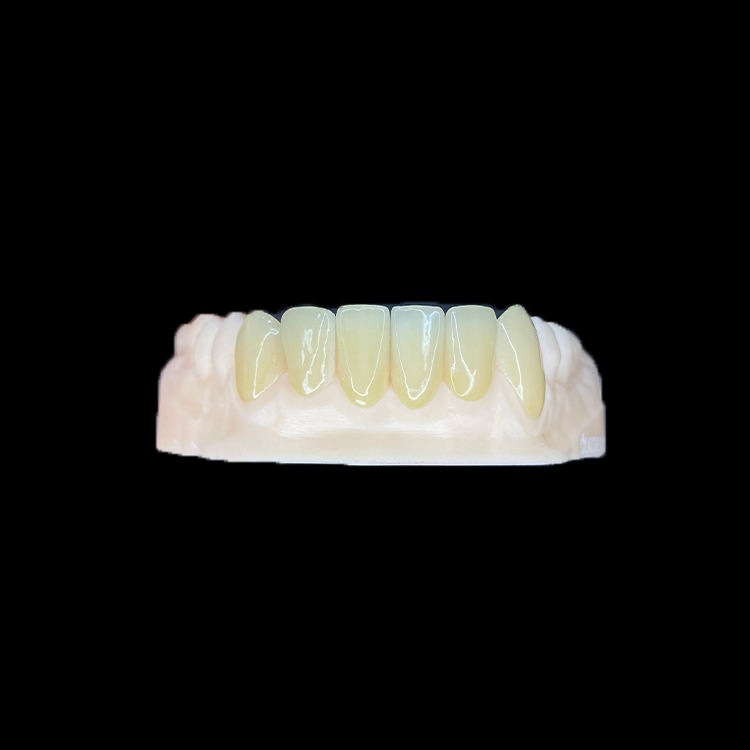 Zirconia Veneers
